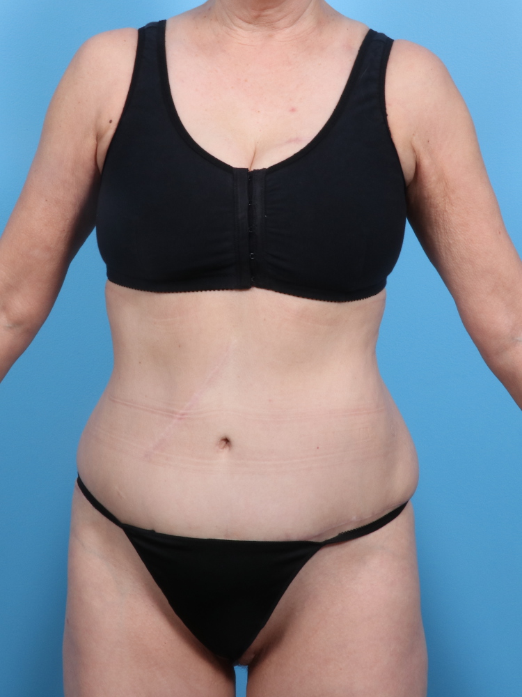 Tummy Tuck - Case 1815 - After