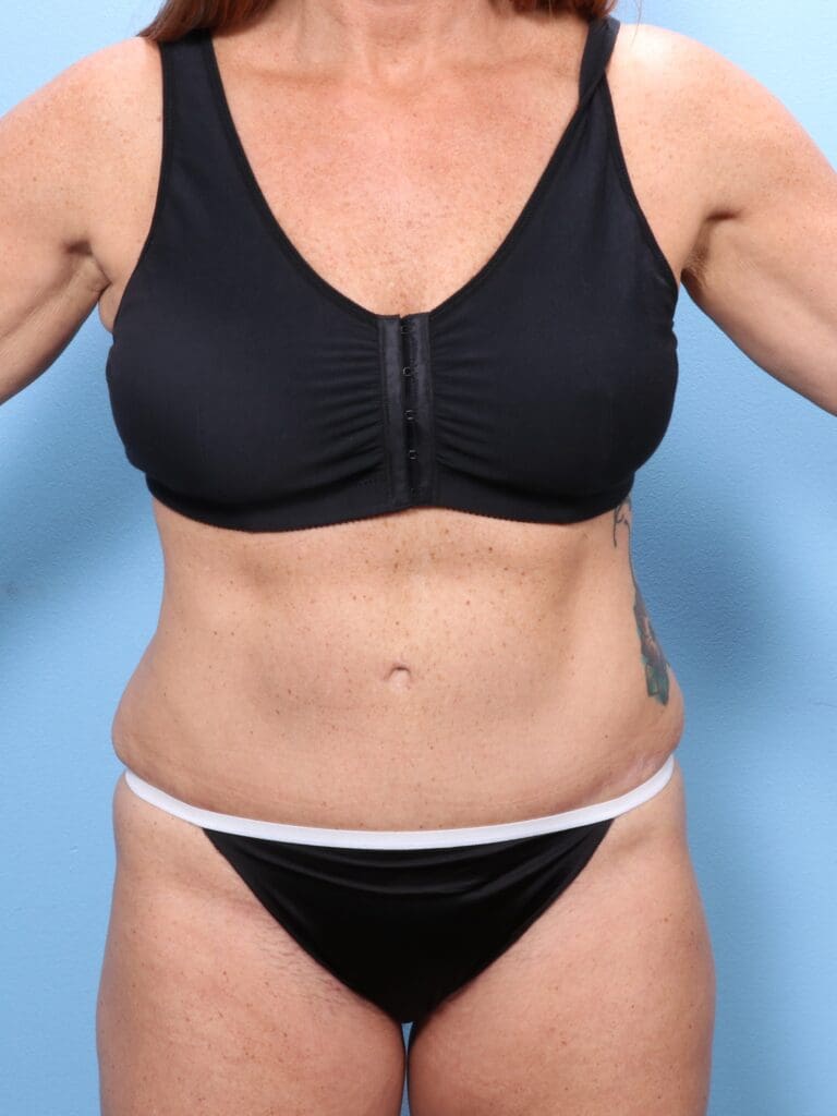 Tummy Tuck - Case 1706 - After