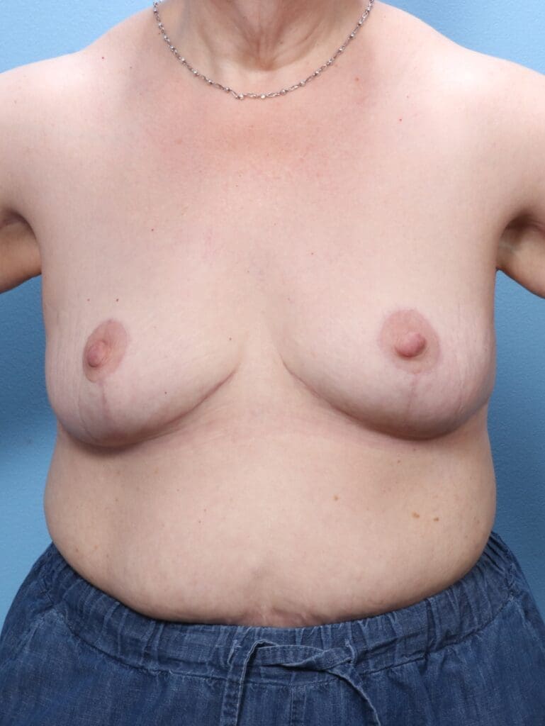 Breast Lift/Reduction w/o Implants - Case 1729 - After