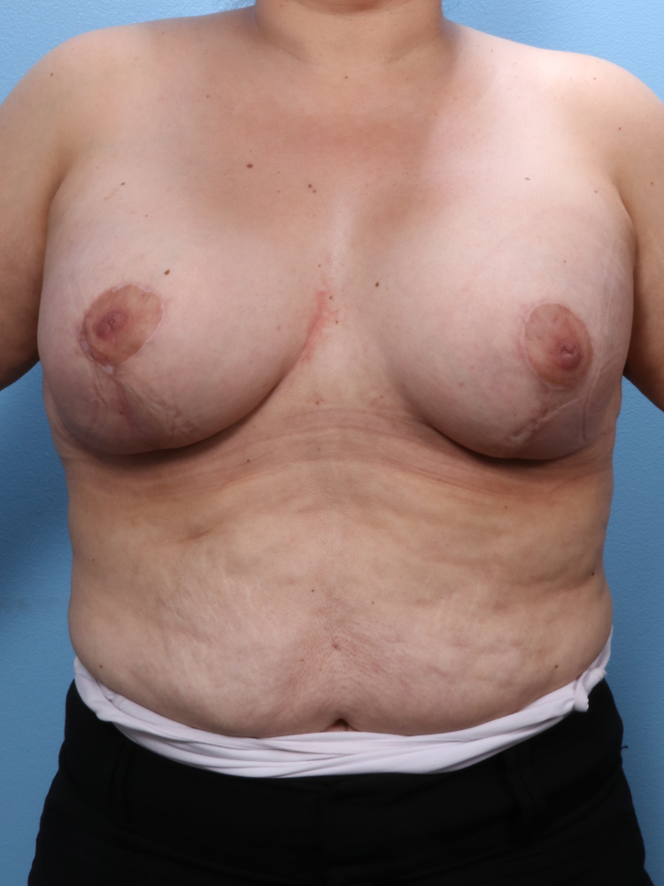 Breast Lift/Reduction with Implants - Case 1751 - After
