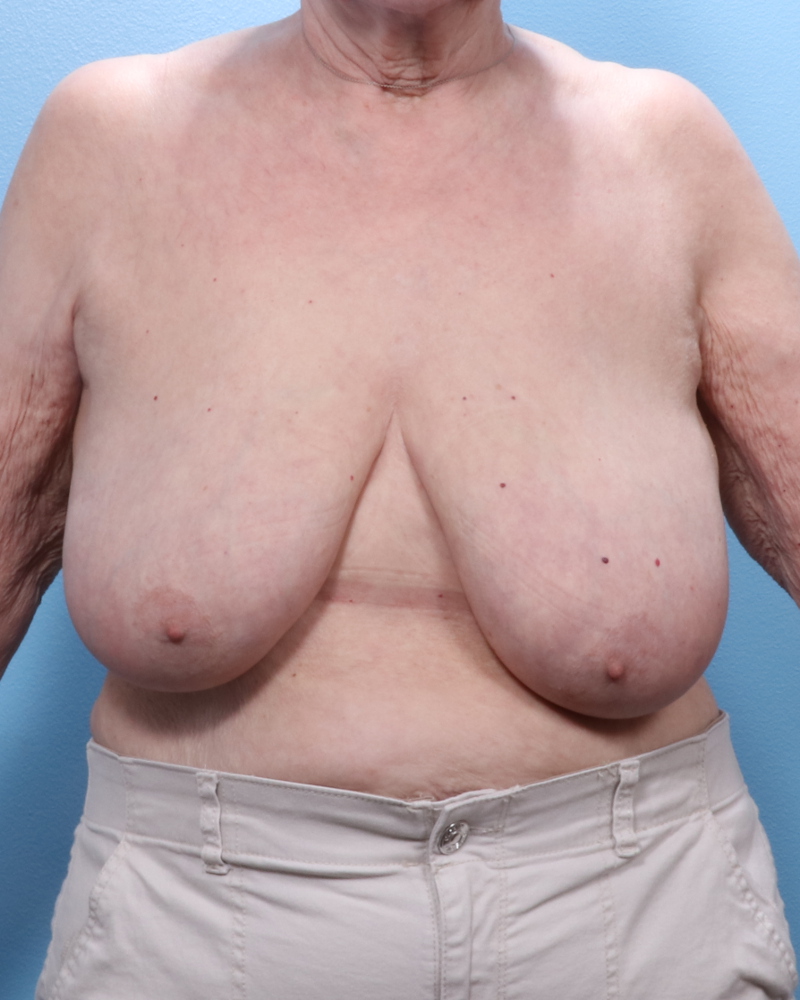 Breast Lift/Reduction w/o Implants - Case 1903 - Before