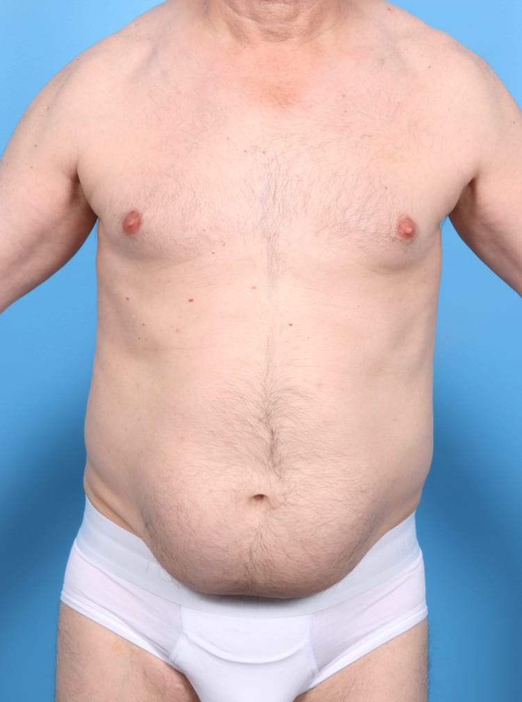 Male Liposuction - Case 16864 - Before