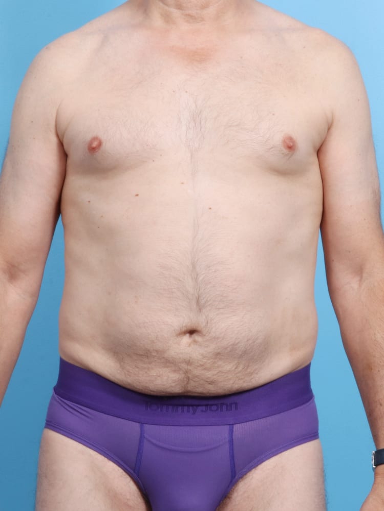 Male Liposuction - Case 16864 - After