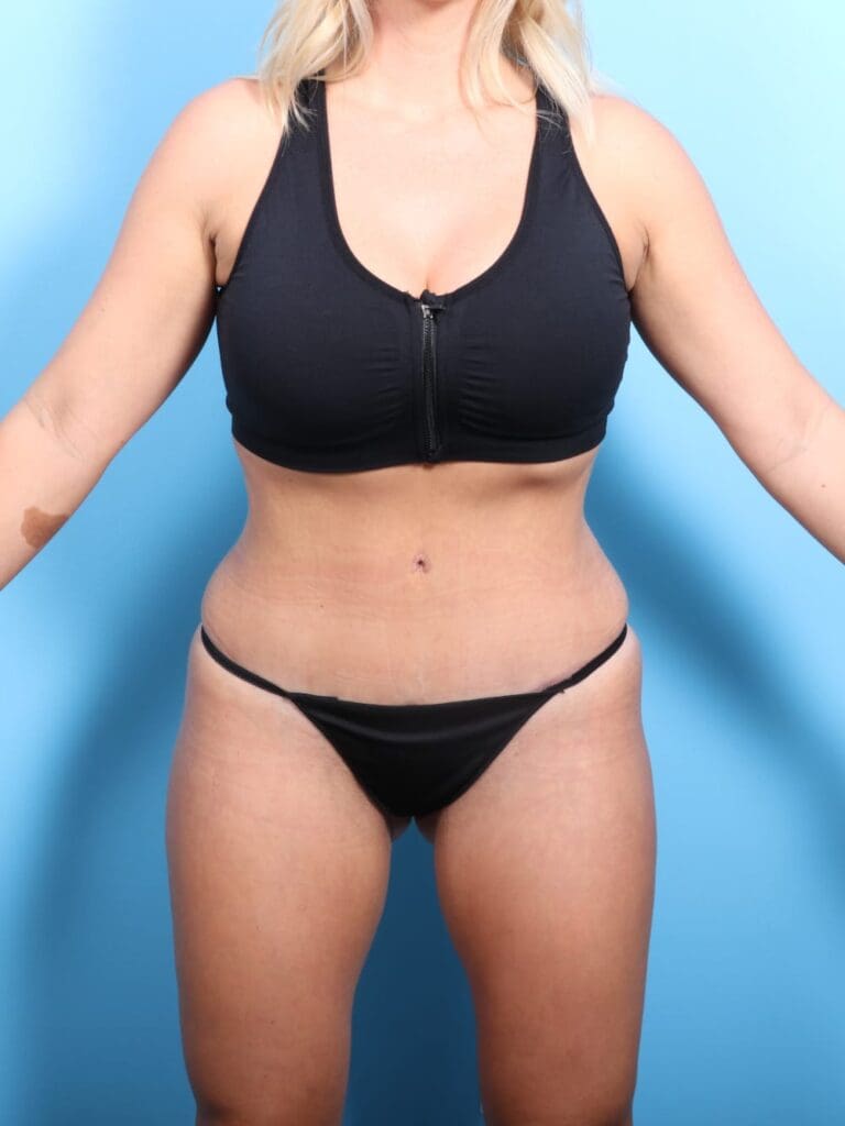 Tummy Tuck - Case 16878 - After