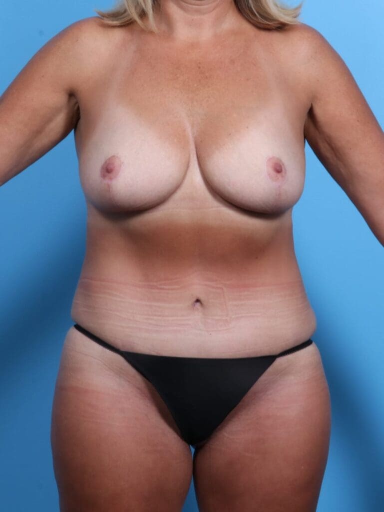 Breast Lift/Reduction w/o Implants - Case 16958 - After