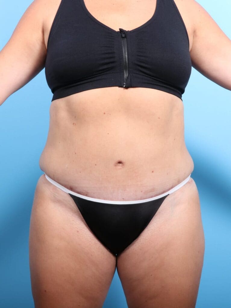 Tummy Tuck - Case 16968 - After