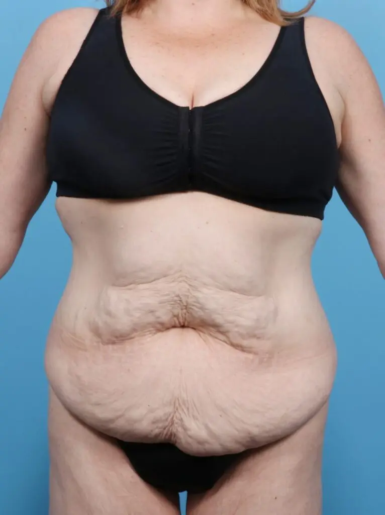 After Weight Loss - Case 16982 - Before