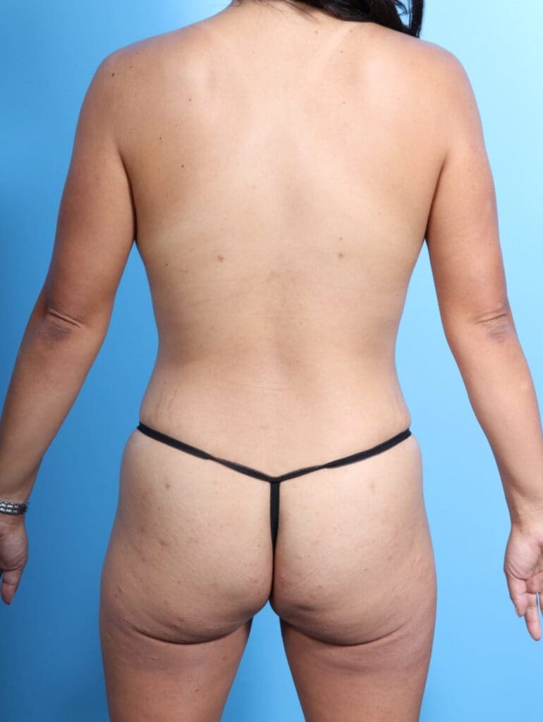 Liposuction - Case 16905 - After