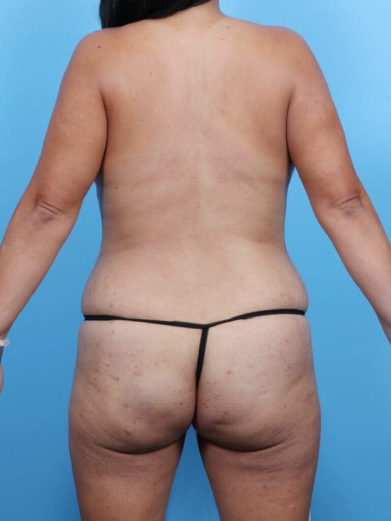 Liposuction - Case 16905 - Before