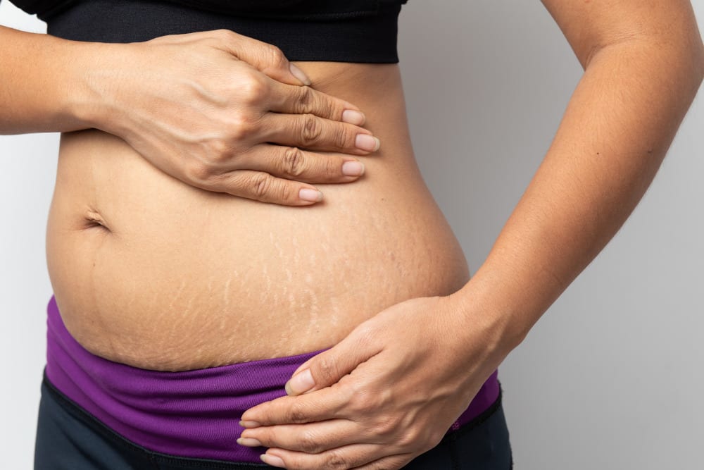 Women showing stretch marks on her abdomen in front of white background.