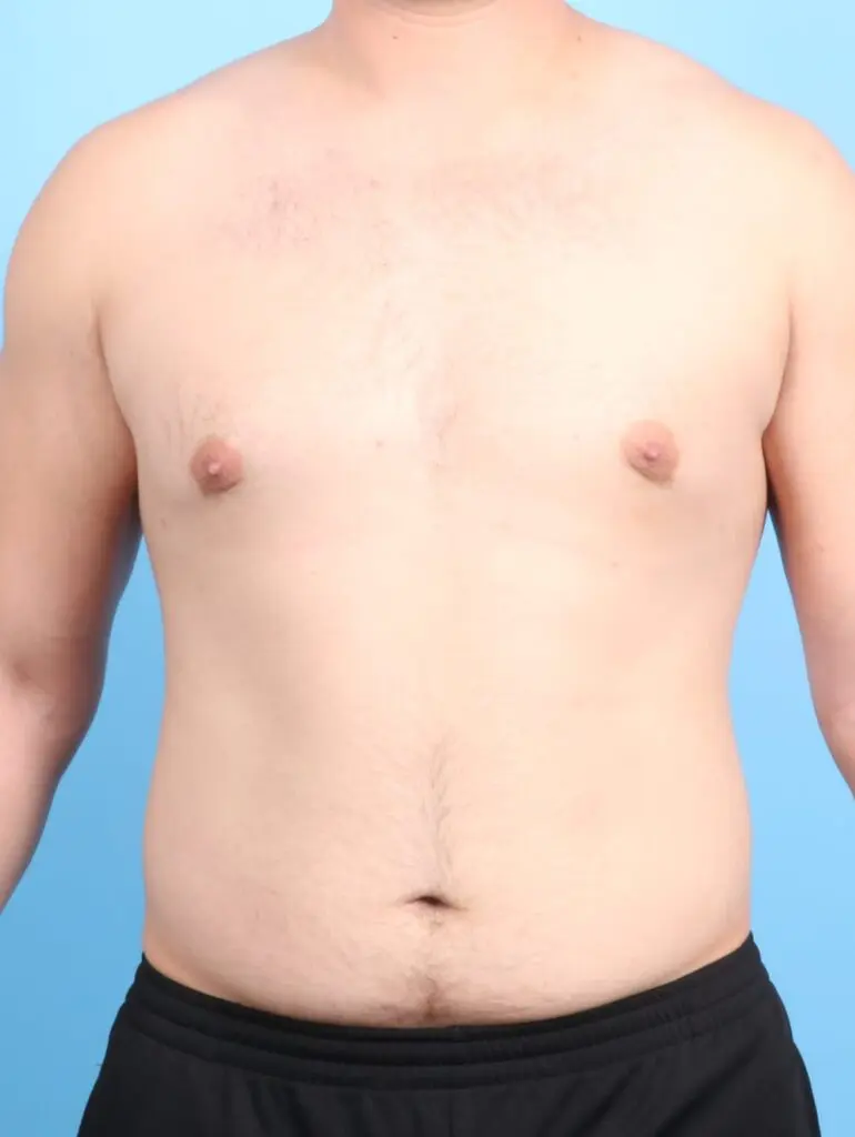 Gynecomastia Before & After, Case 10