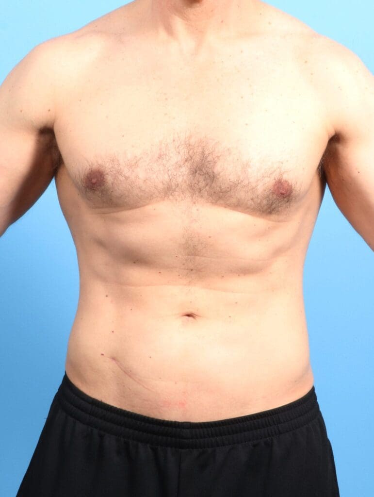 Male Liposuction - Case 19905 - After