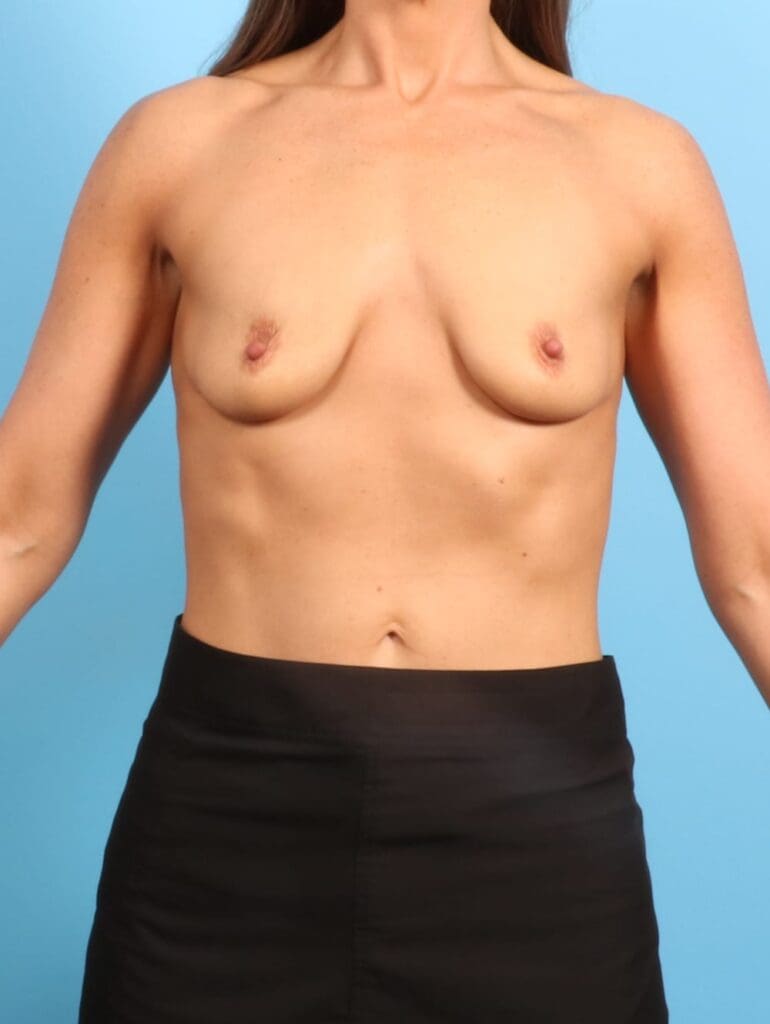 Breast Lift/Reduction with Implants - Case 20080 - Before