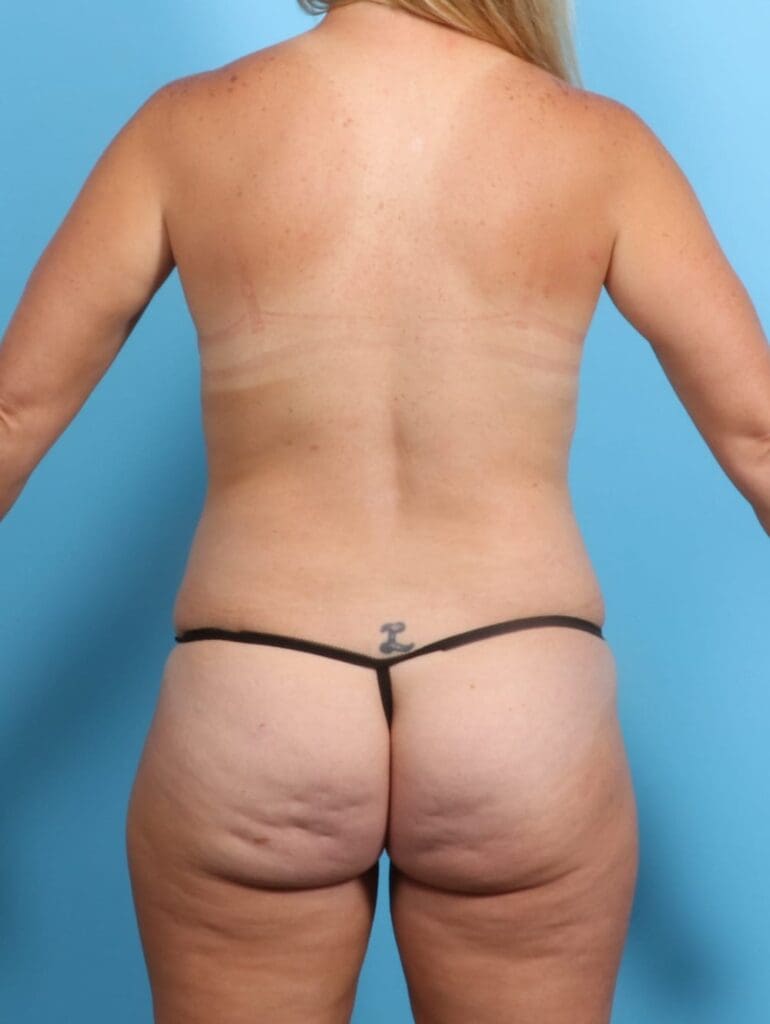 Liposuction - Case 20286 - Before