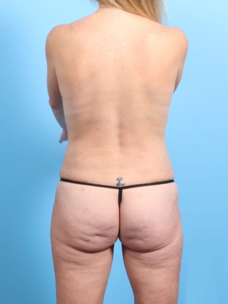 Liposuction - Case 20286 - After