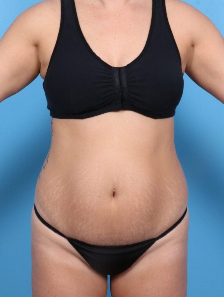 Liposuction - Case 20571 - Before