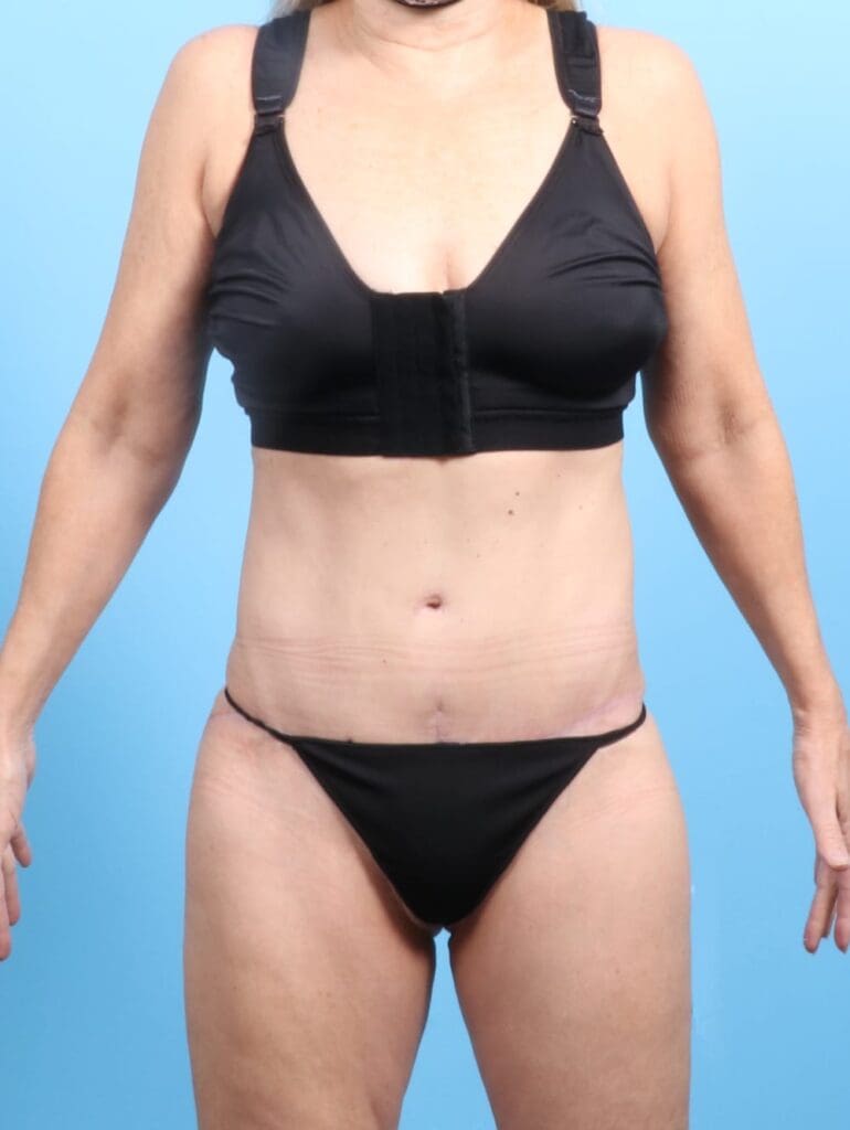 Tummy Tuck - Case 20620 - After