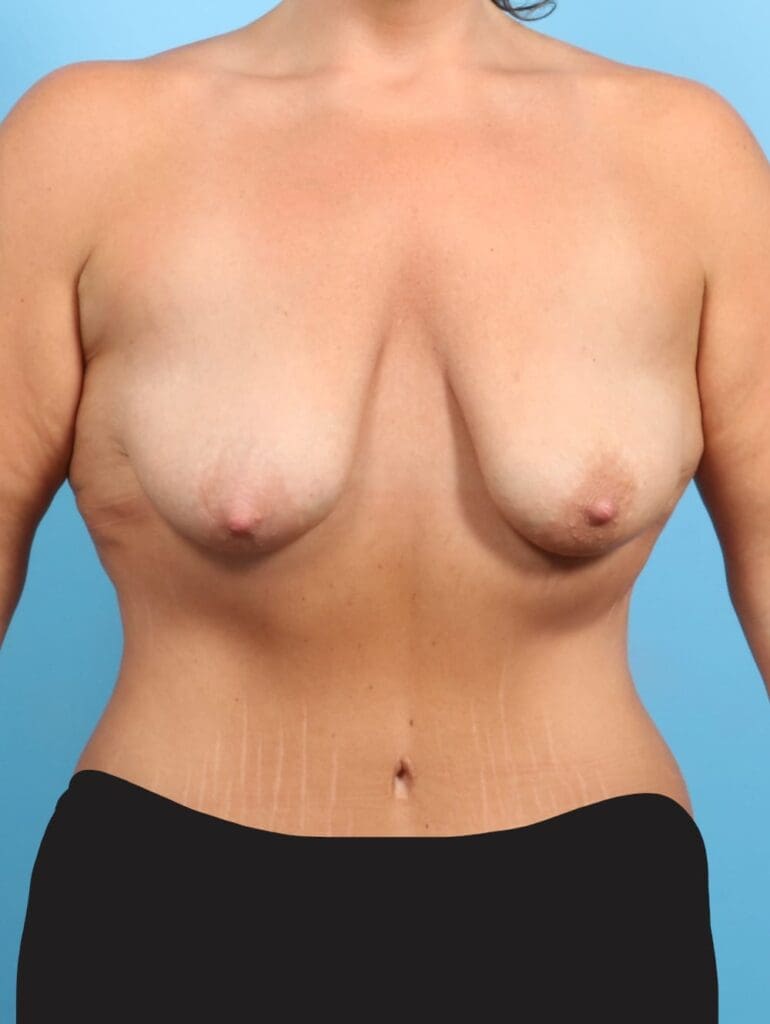 Breast Lift/Reduction with Implants - Case 21244 - Before