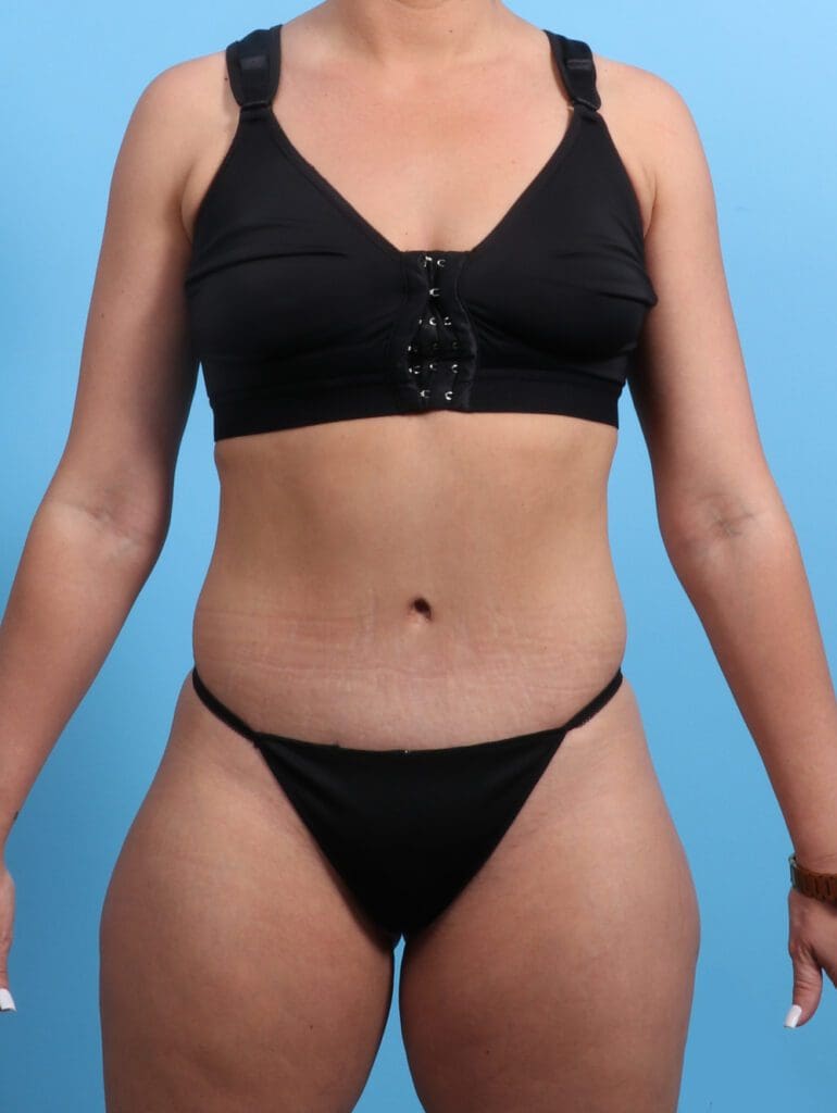 Tummy Tuck - Case 21705 - After