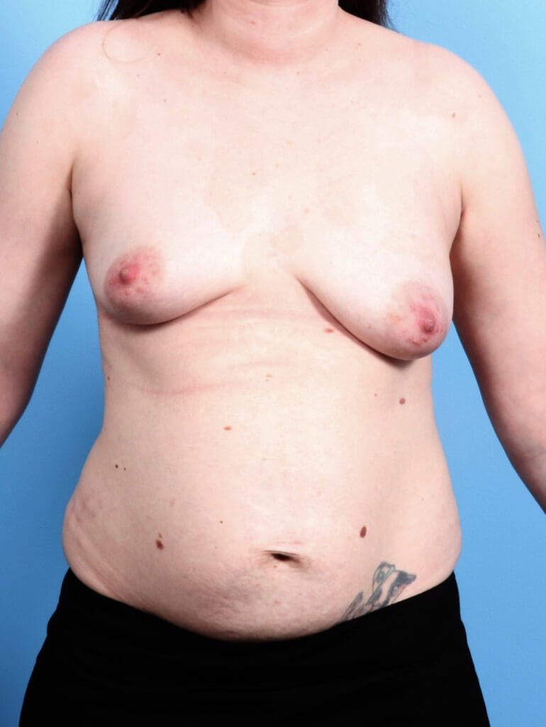 Breast Lift/Reduction with Implants - Case 21843 - Before