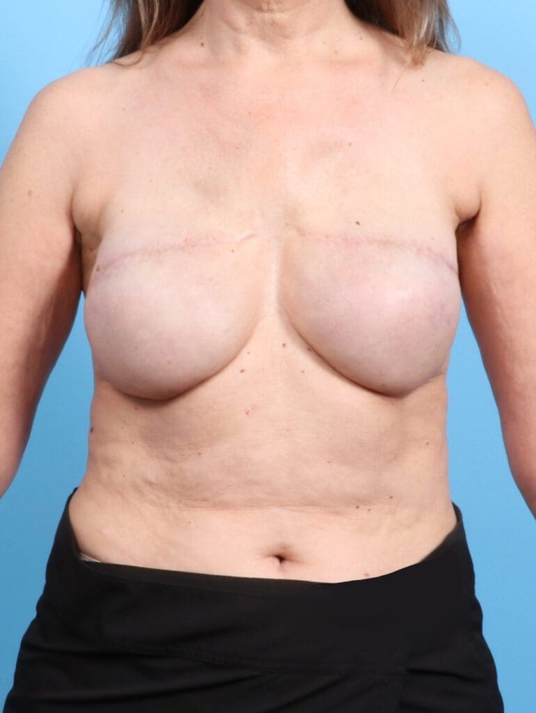 Breast Implant Revision - Case 21960 - Before