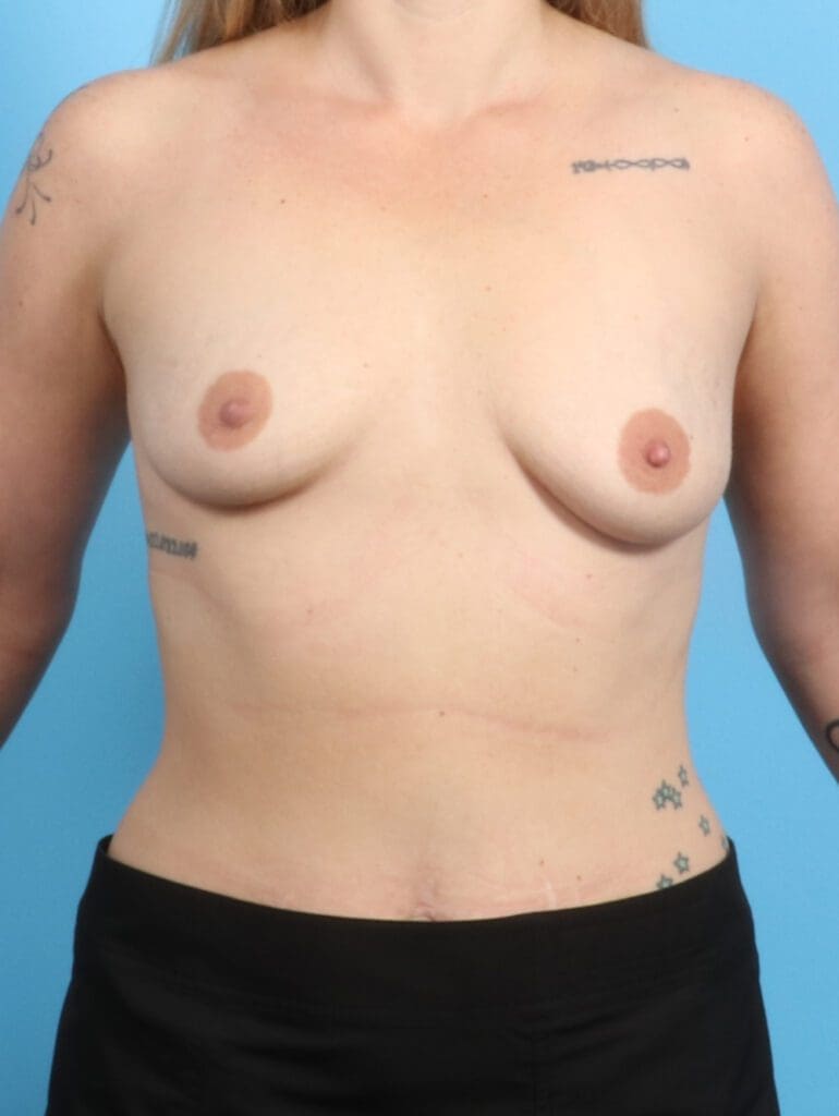Breast Lift/Reduction with Implants - Case 22278 - Before