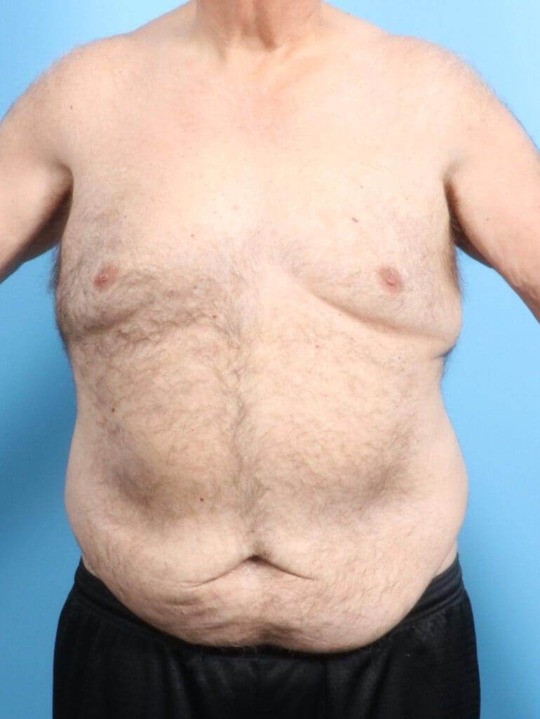 After Weight Loss - Case 22829 - Before