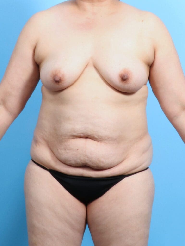 Breast Lift/Reduction with Implants - Case 23287 - Before