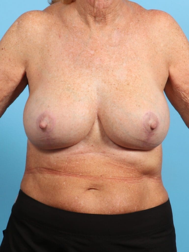 Breast Implant Revision - Case 23382 - After