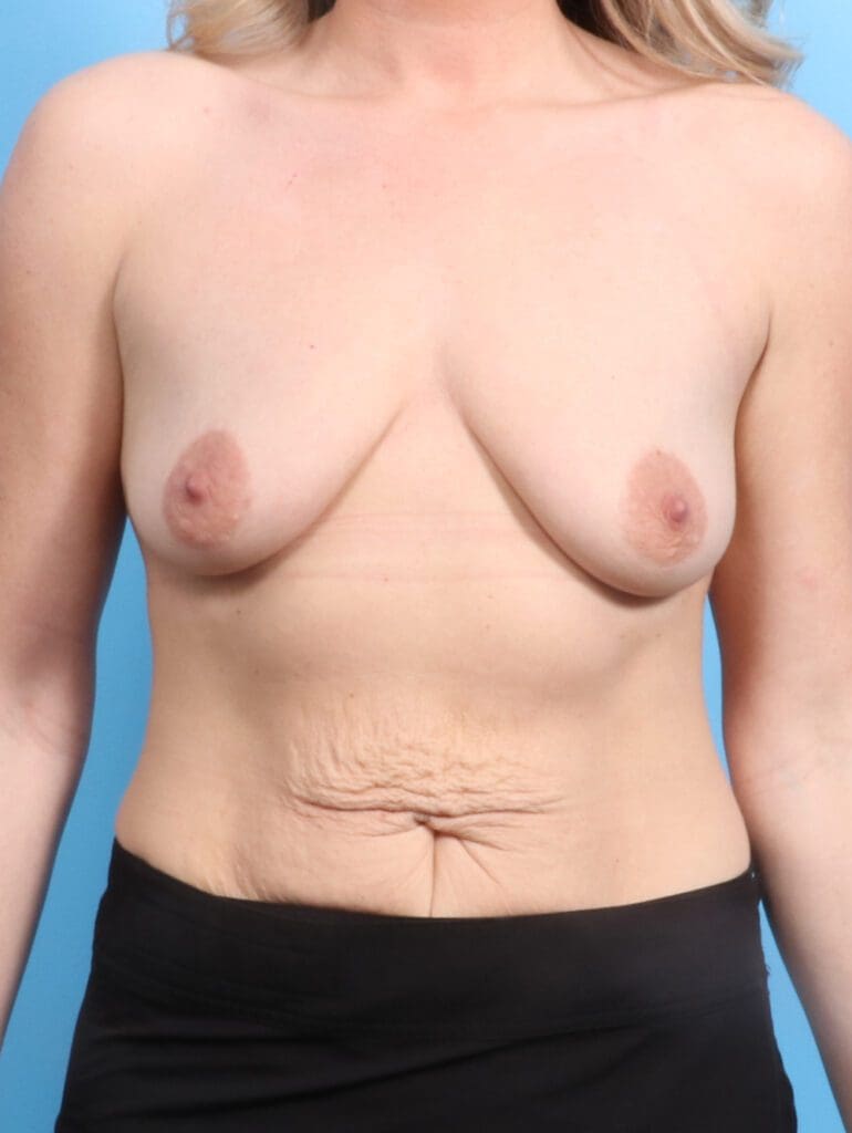 Breast Lift/Reduction with Implants - Case 24085 - Before