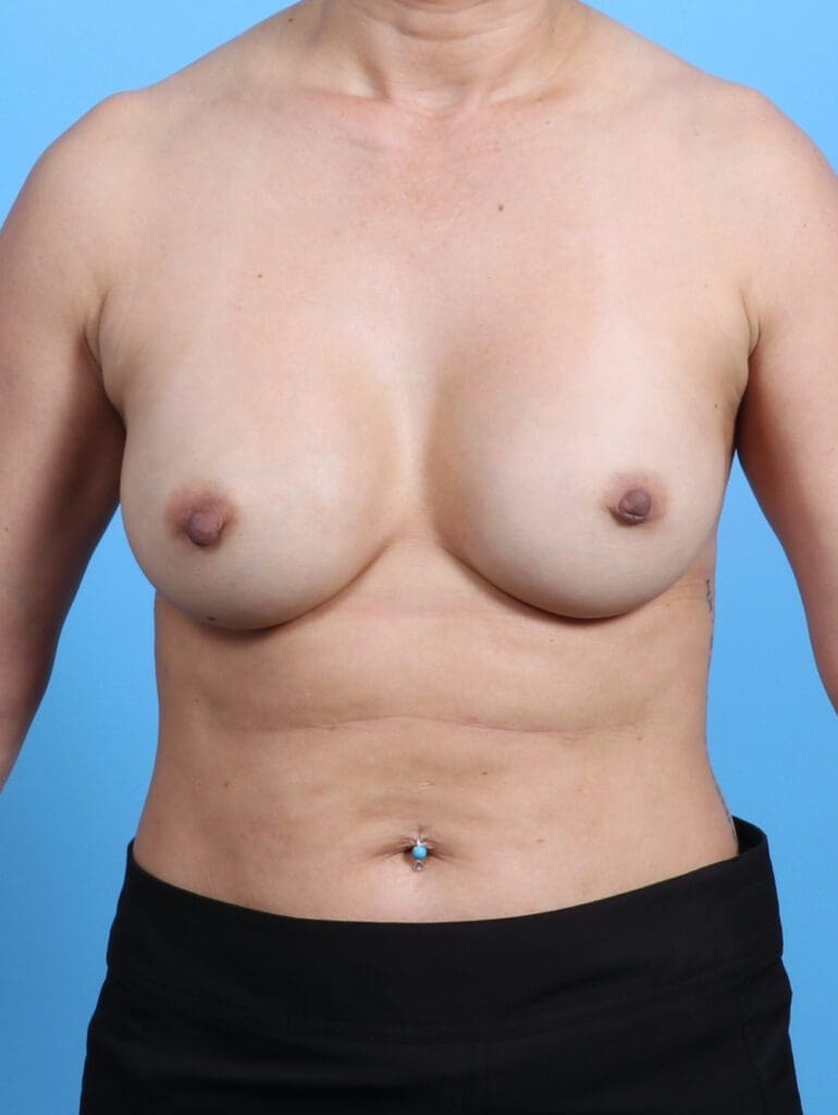 Breast Implant Revision - Case 24350 - Before