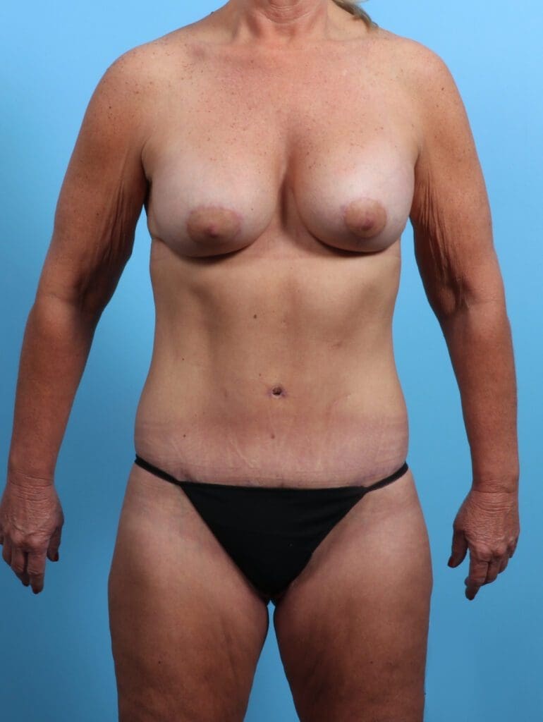 After Weight Loss - Case 25157 - After