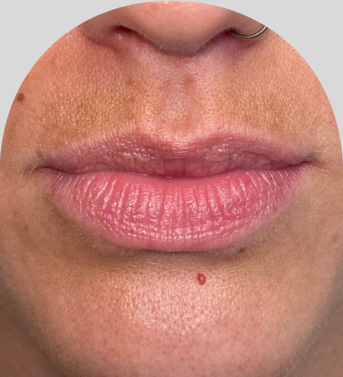 Lip Fillers - Case 25427 - Before
