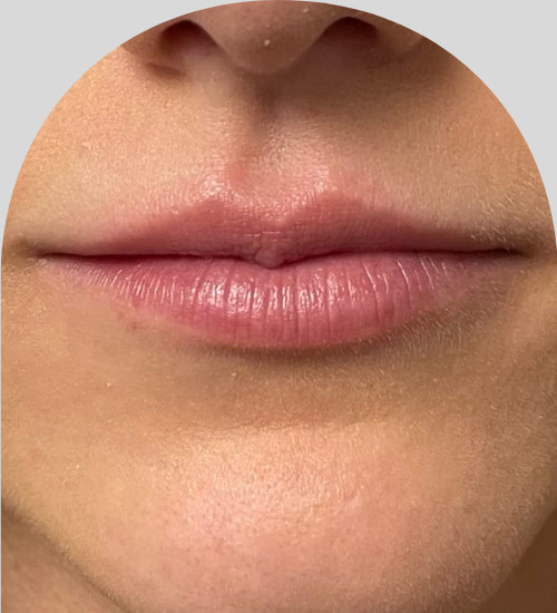 Lip Fillers - Case 25439 - Before