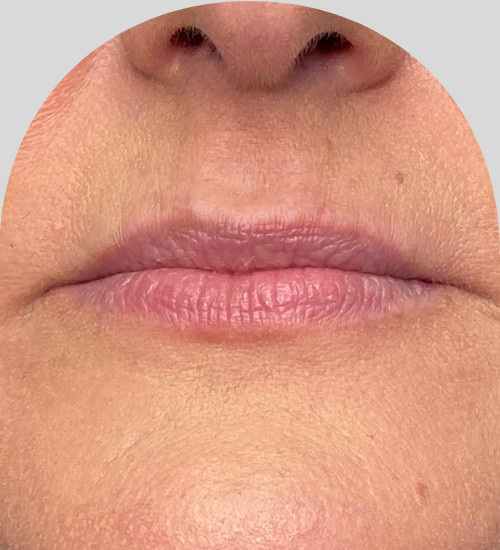 Lip Fillers - Case 25443 - Before
