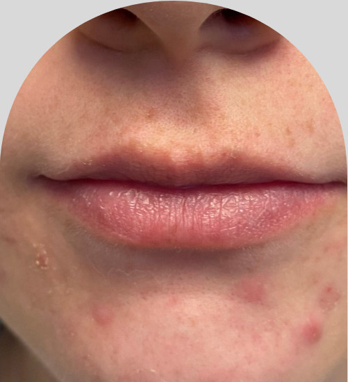 Lip Fillers - Case 25451 - Before