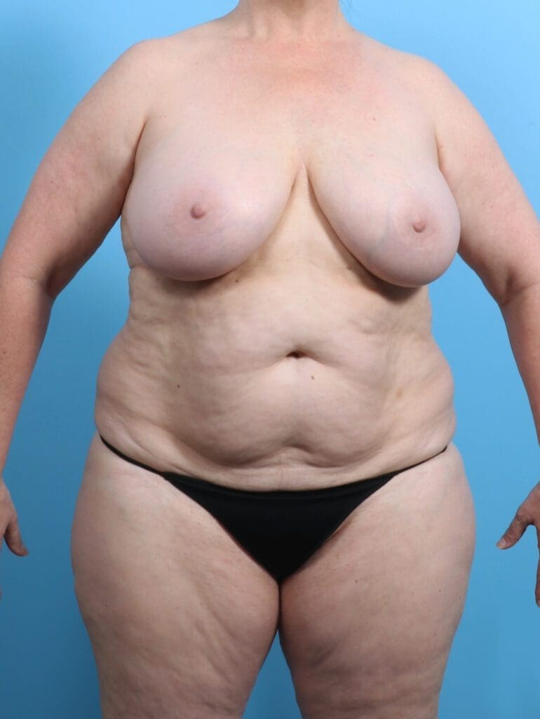 Breast Lift/Reduction w/o Implants - Case 25791 - Before