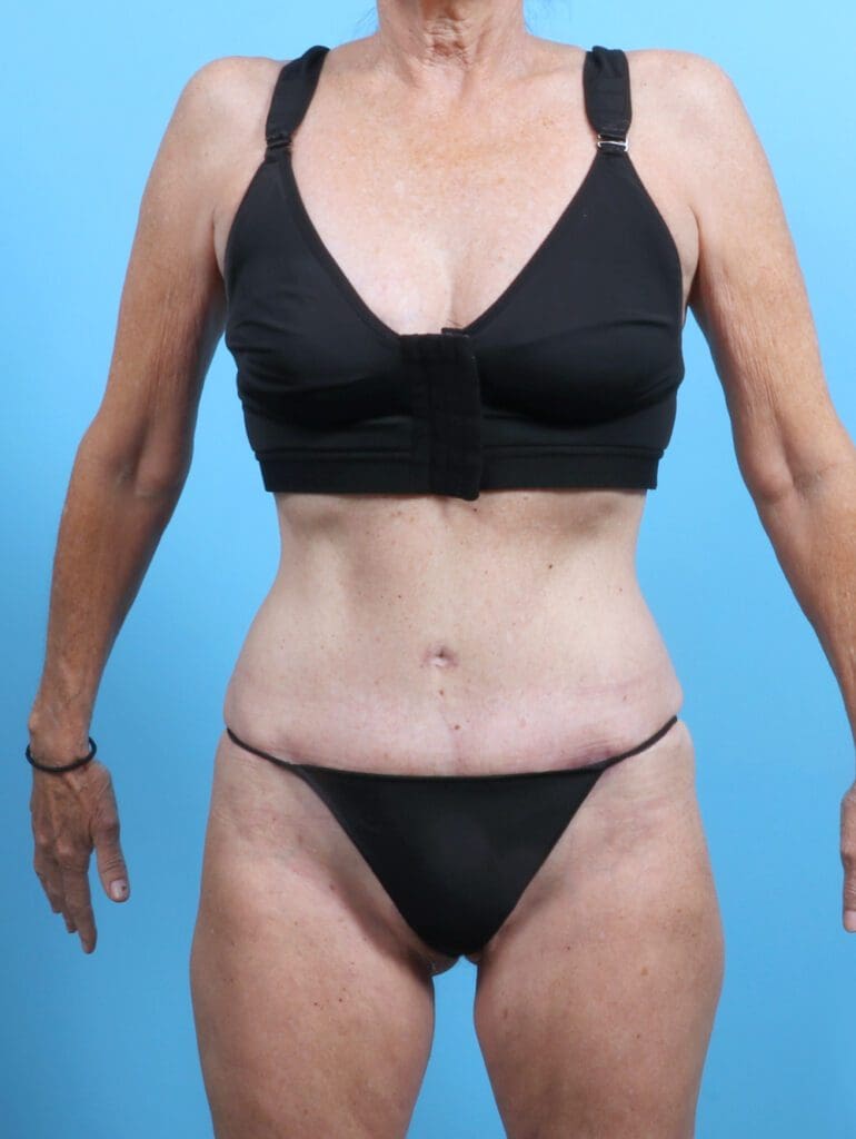 Tummy Tuck - Case 25801 - After