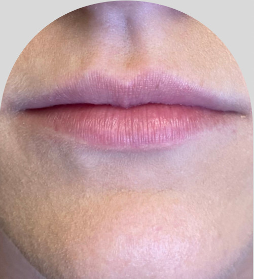 Lip Fillers - Case 26543 - Before