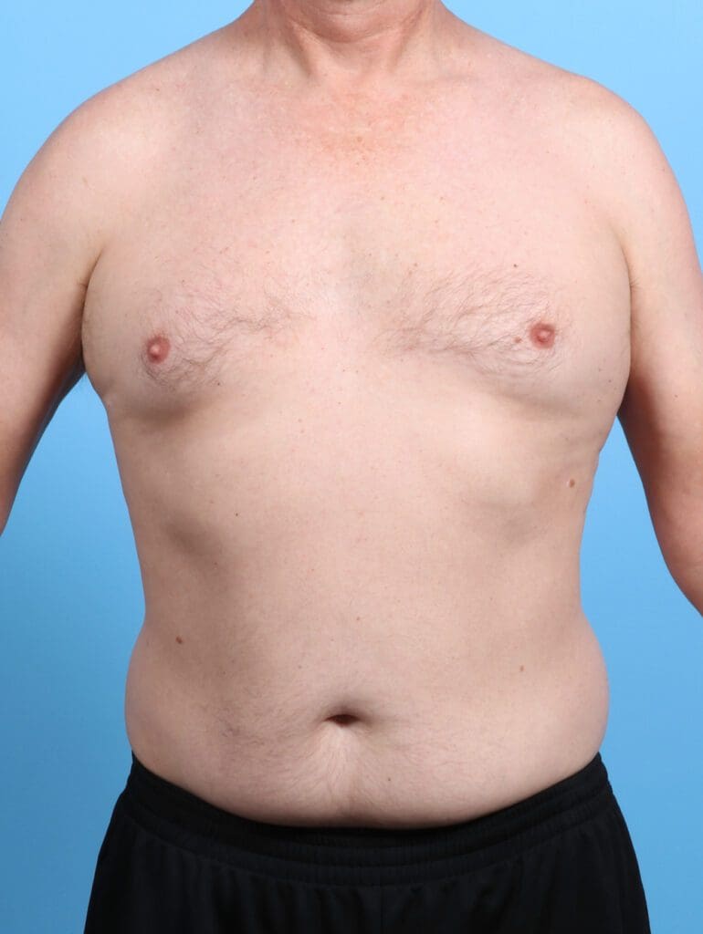 Male Liposuction - Case 26626 - Before
