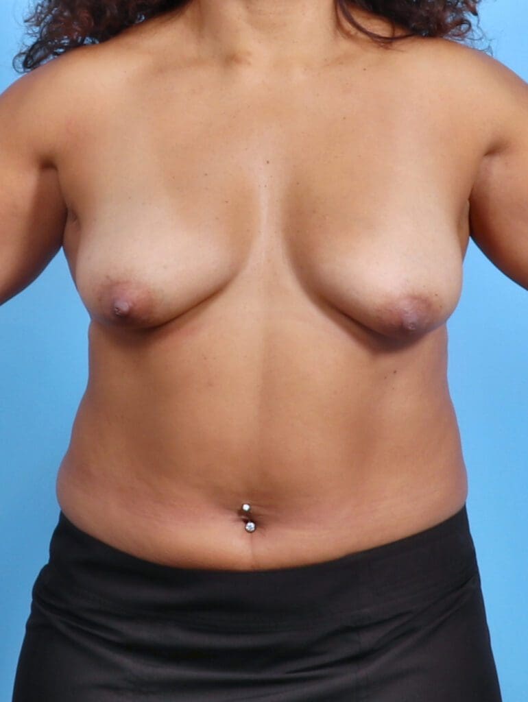 Breast Lift/Reduction with Implants - Case 26648 - Before