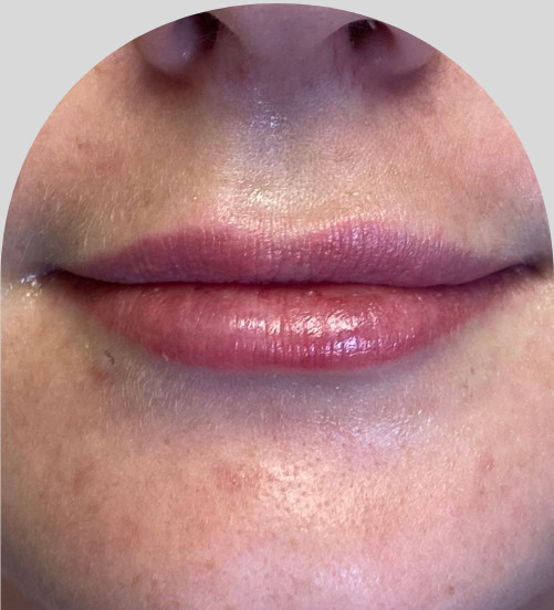 Lip Fillers - Case 26775 - Before