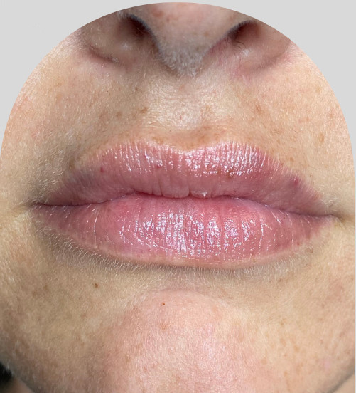 Lip Fillers - Case 26903 - Before