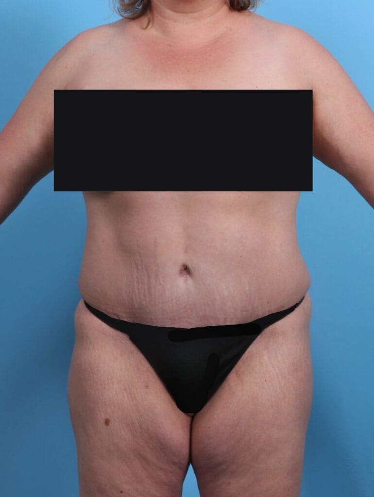 Tummy Tuck - Case 27432 - After