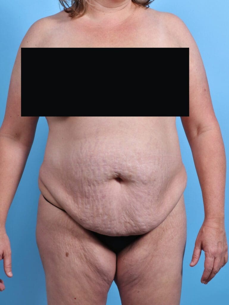 Tummy Tuck - Case 27432 - Before