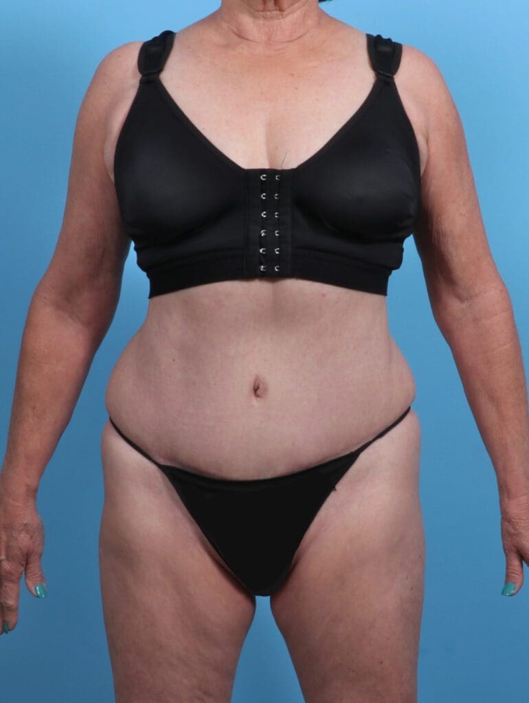 Tummy Tuck - Case 27489 - After