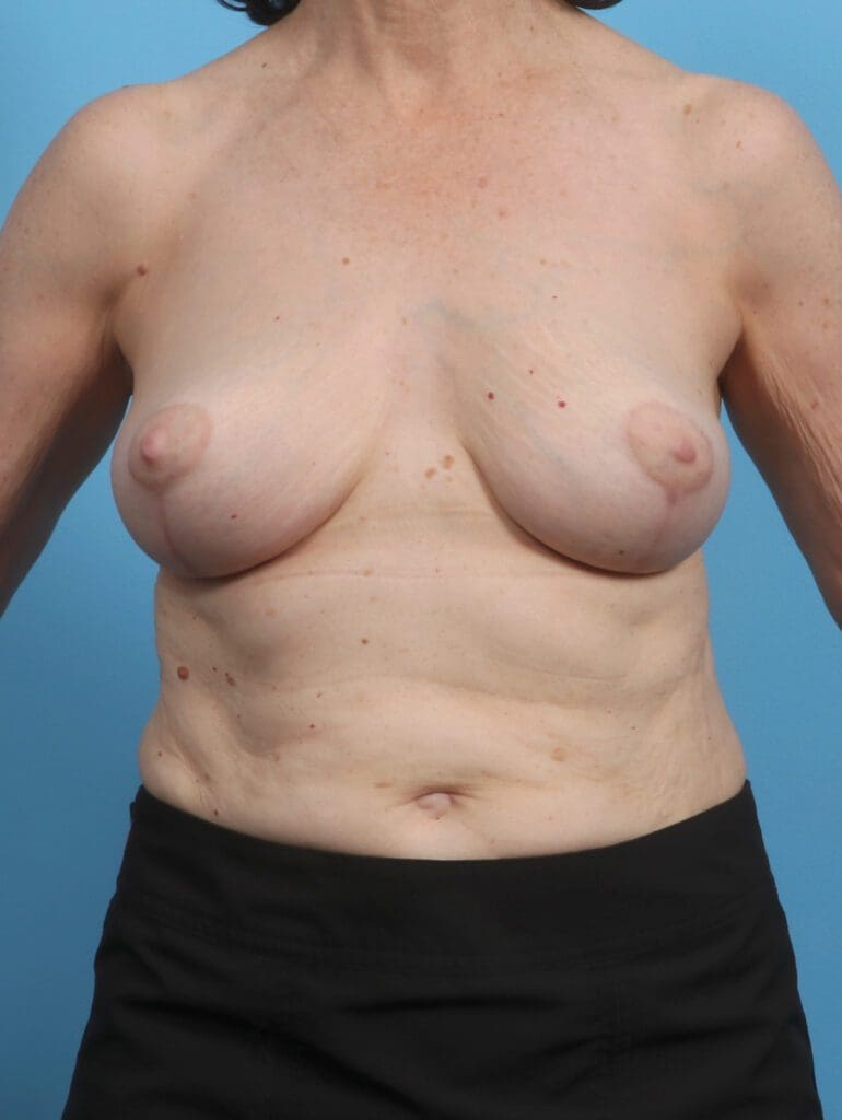 Breast Lift/Reduction w/o Implants - Case 27612 - After