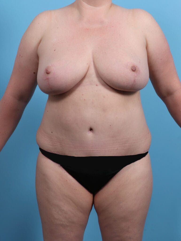 Breast Lift/Reduction w/o Implants - Case 27628 - After