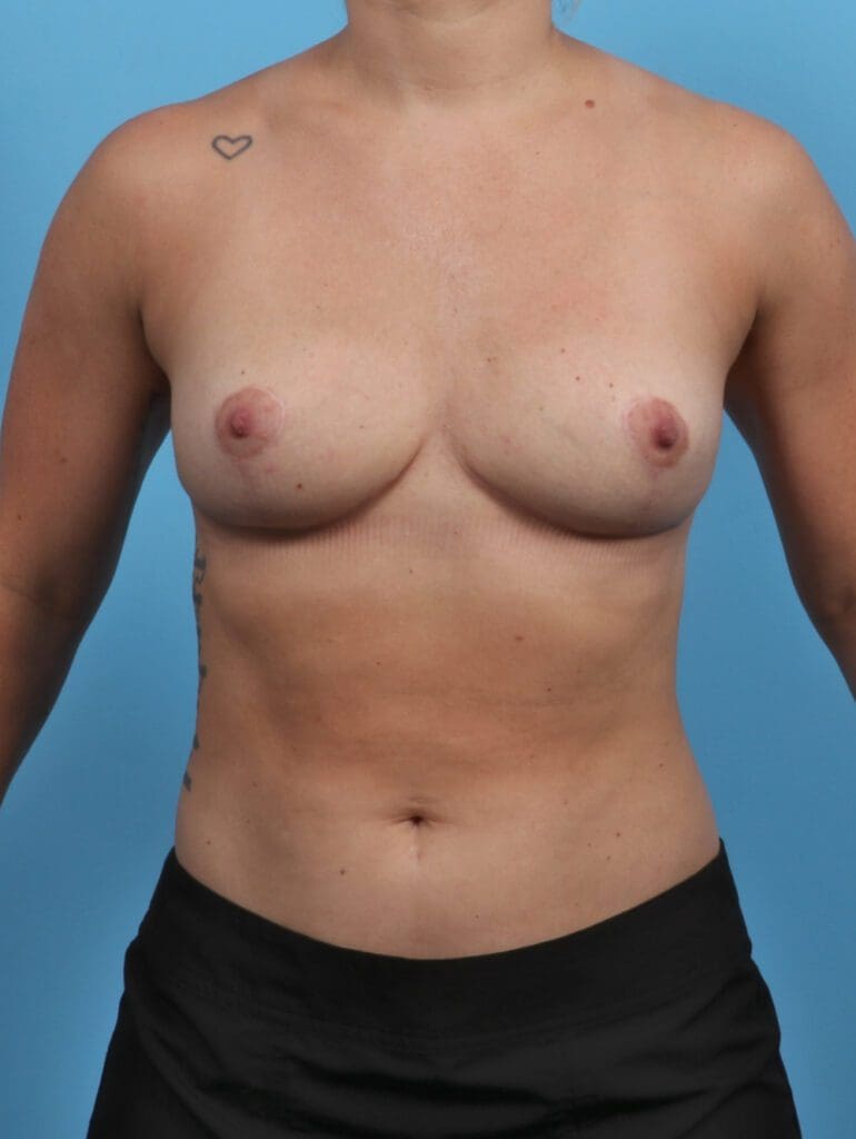 Breast Implant Removal - Case 27655 - After