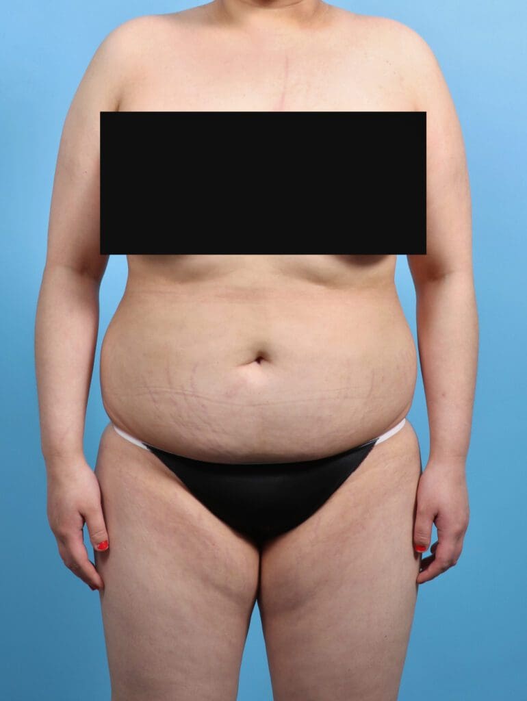 Liposuction - Case 27679 - Before